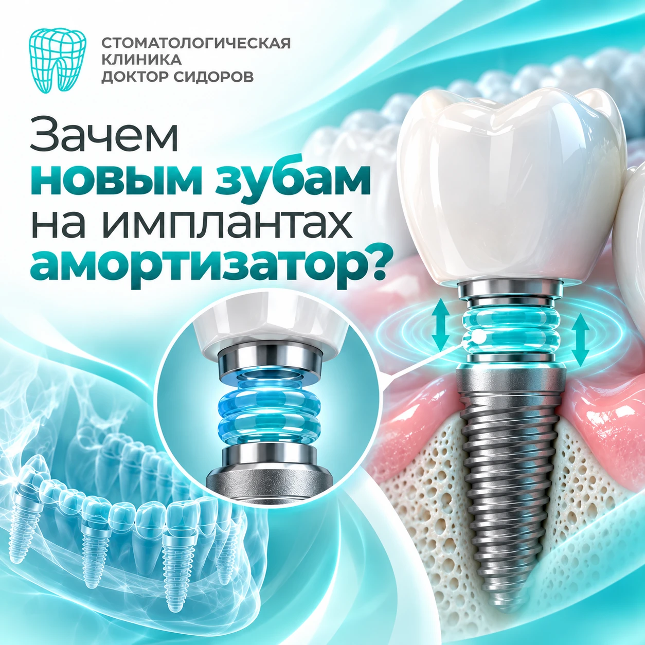 🦷 Зачем новым зубам на имплантах амортизатор?