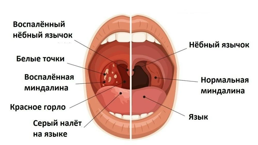Почему в миндалинах образуются «пробки» и что с этим делать?Неприятный запах изо рта, чувство инород
