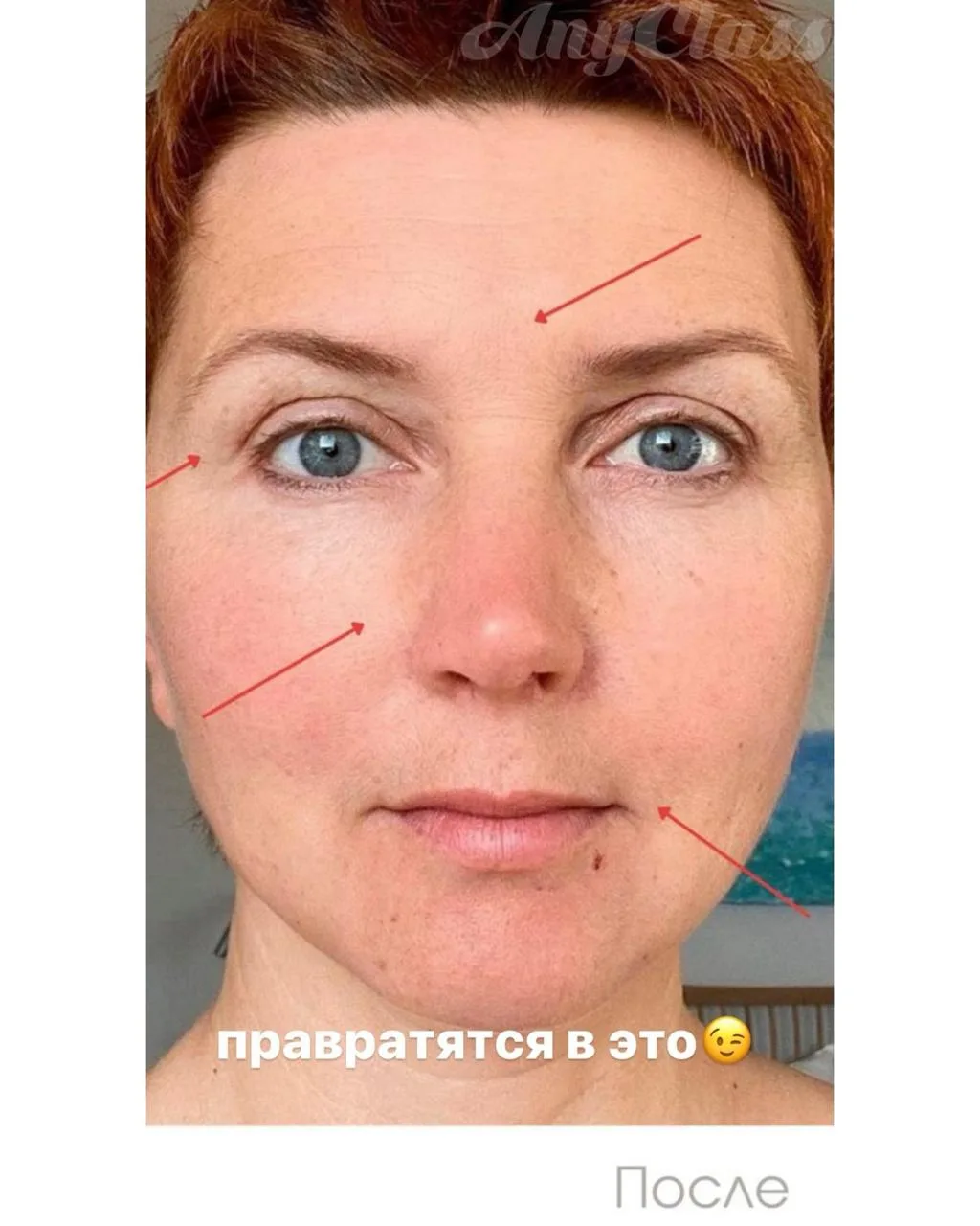 👁️ Когда гусиные лапки - это не конфетки из детства   Прищуриваешься перед экраном? Смеёшься от души