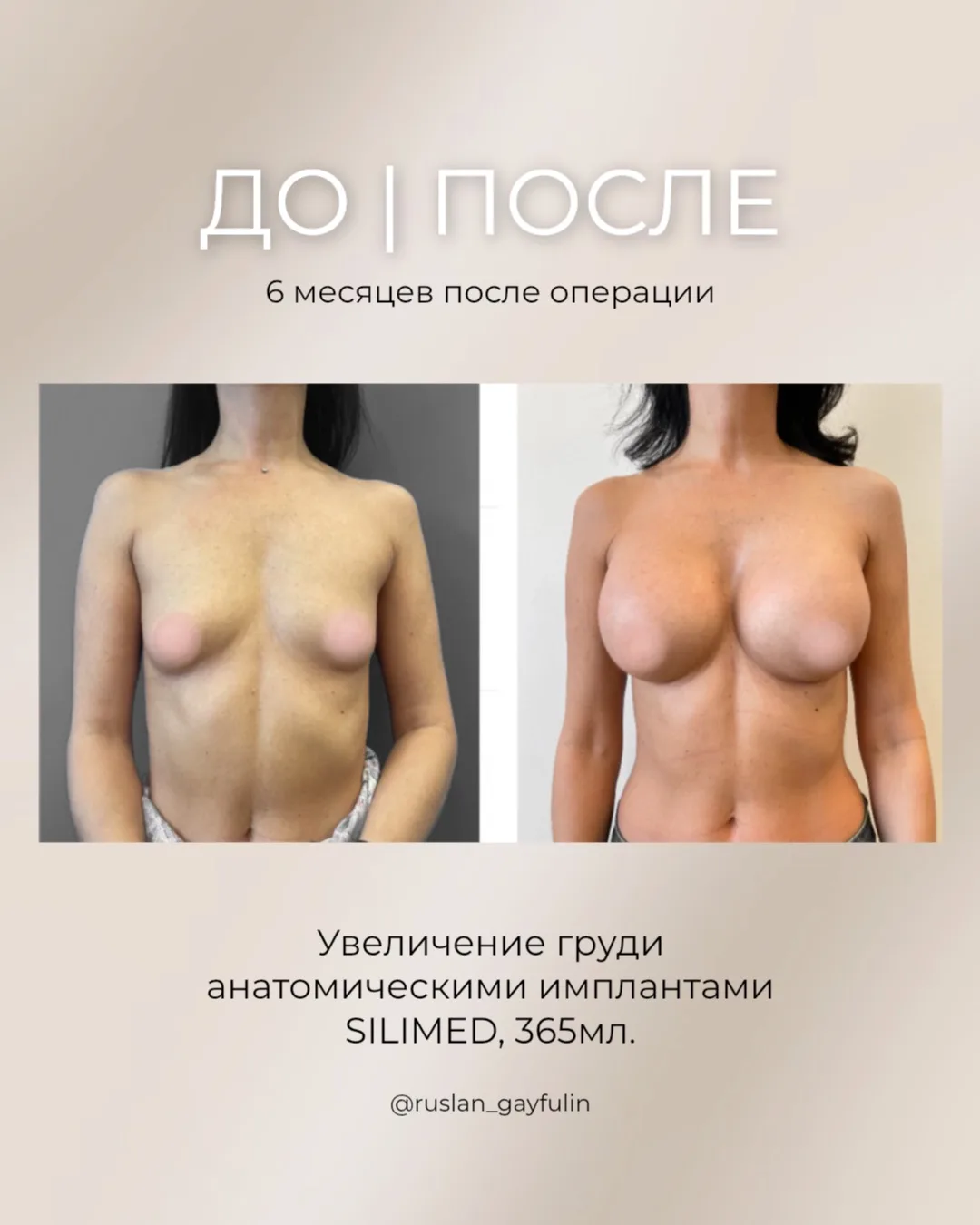 Результат спустя полгода после увеличения груди анатомическими имплантами SILIMED, 365м...