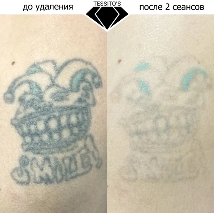 Небольшая подборка удаления неудачных татуировок👆🏻
 Нет ничего невозможного, свести неудачную тату
