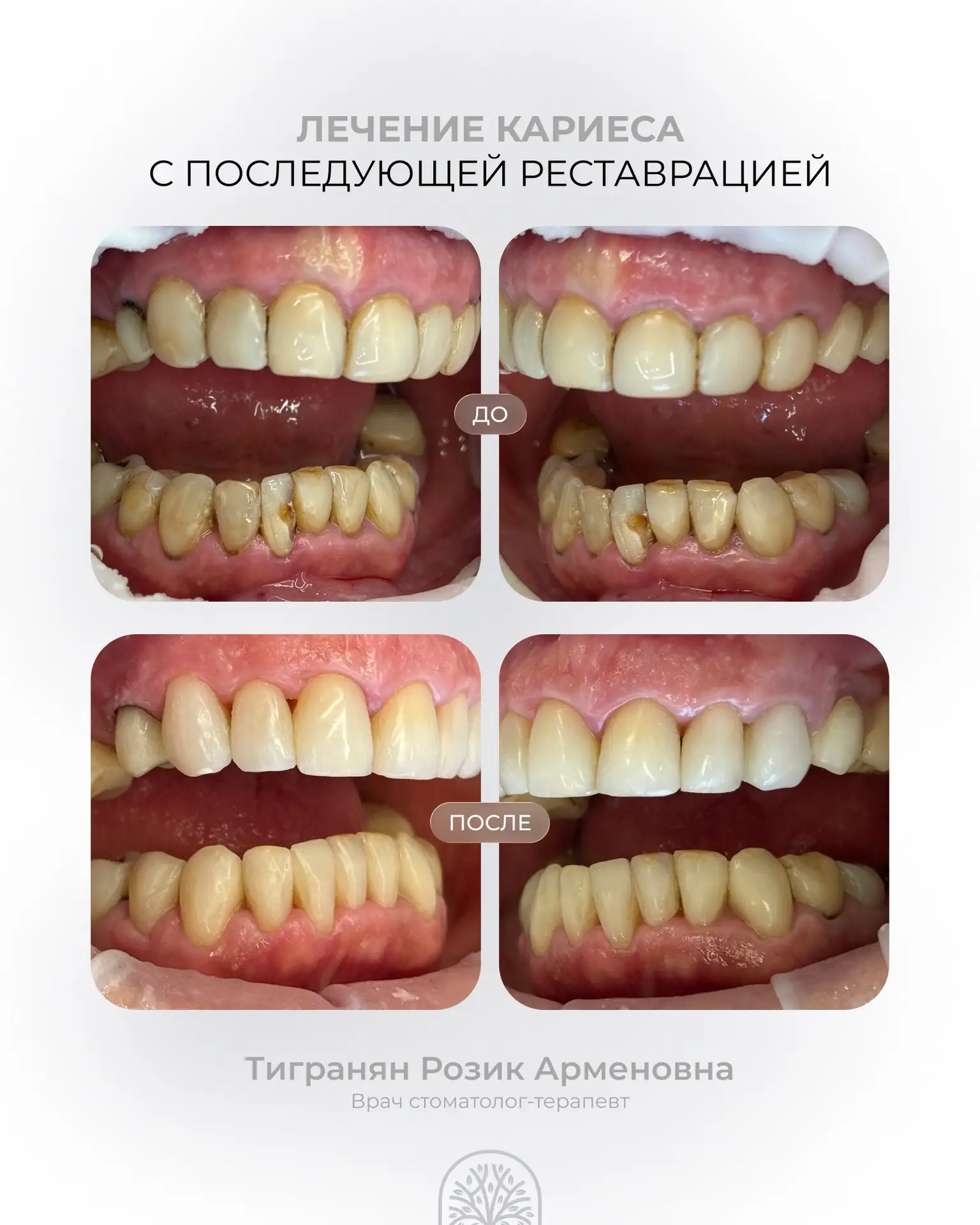 Рады поделиться прекрасным результатом работы нашего стоматолога-терапевта Розик Арменовны Тигранян 