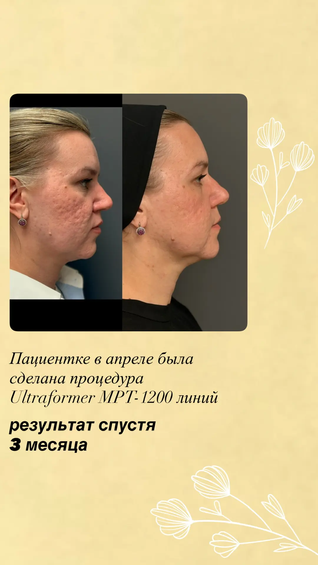 Как Вам результат? Ставьте Ваши реакции! Не устану повторять, Ultraformer MPT всегда по...