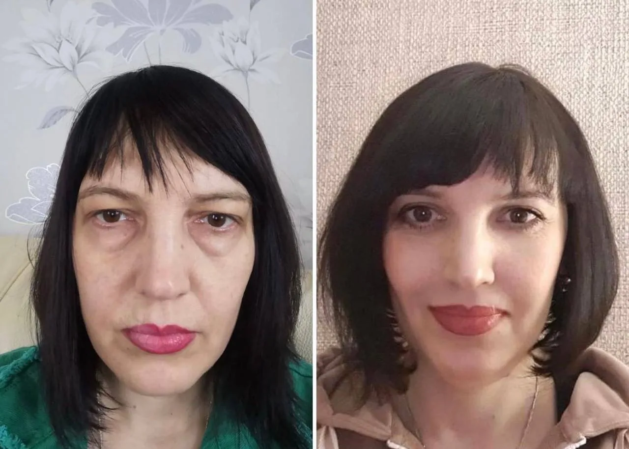 Моя пациентка, выполнившая круговую блефаропластику в 2020 году,
победительница Летнего розыгрыша 20
