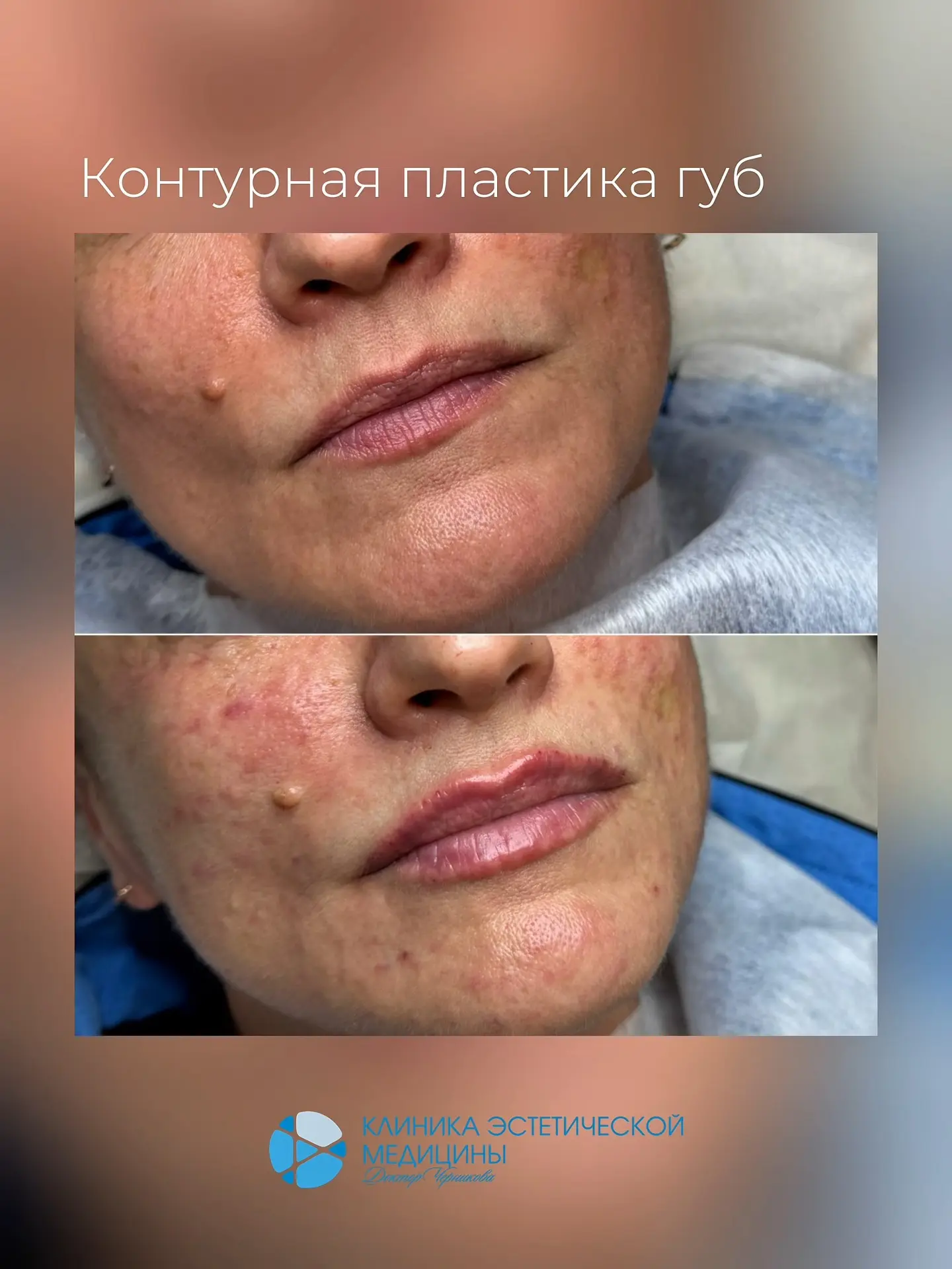 Хотите изменить форму или объём губ, но боитесь, что это будет бросаться в глаза?