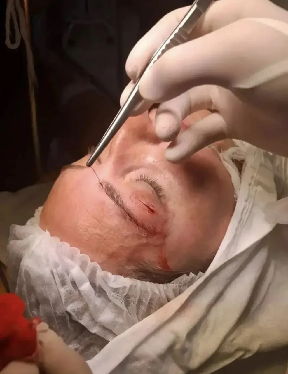 Врачи извлекли живого червя из века пациентки, которая обратилась в больницу с жалобами...