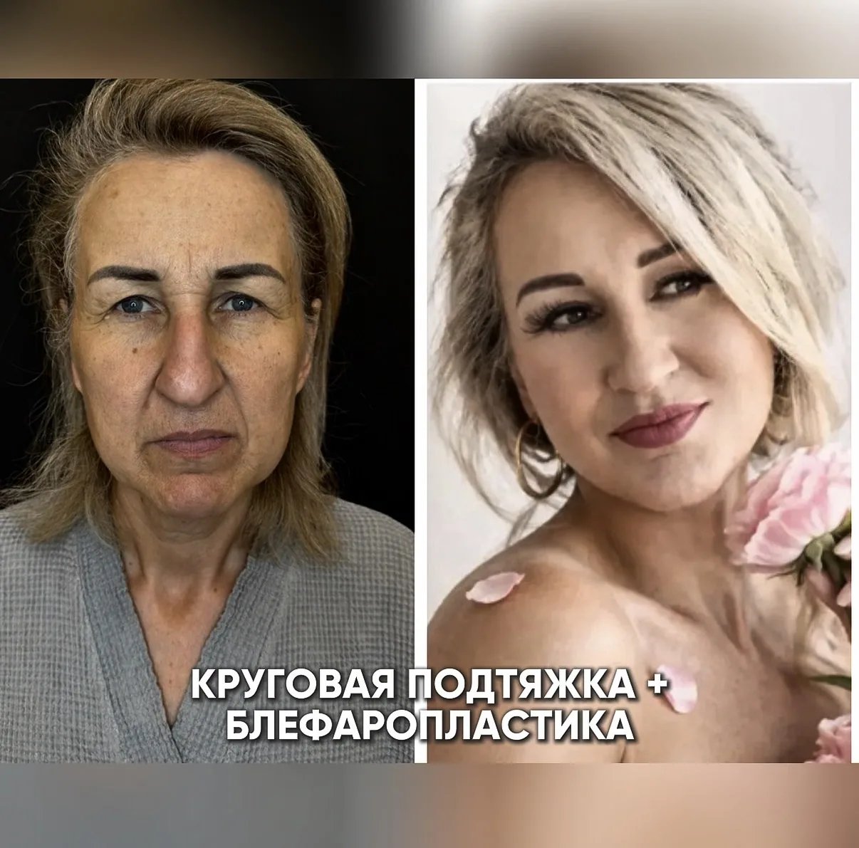 Можно ли эту операцию назвать омолаживающей?