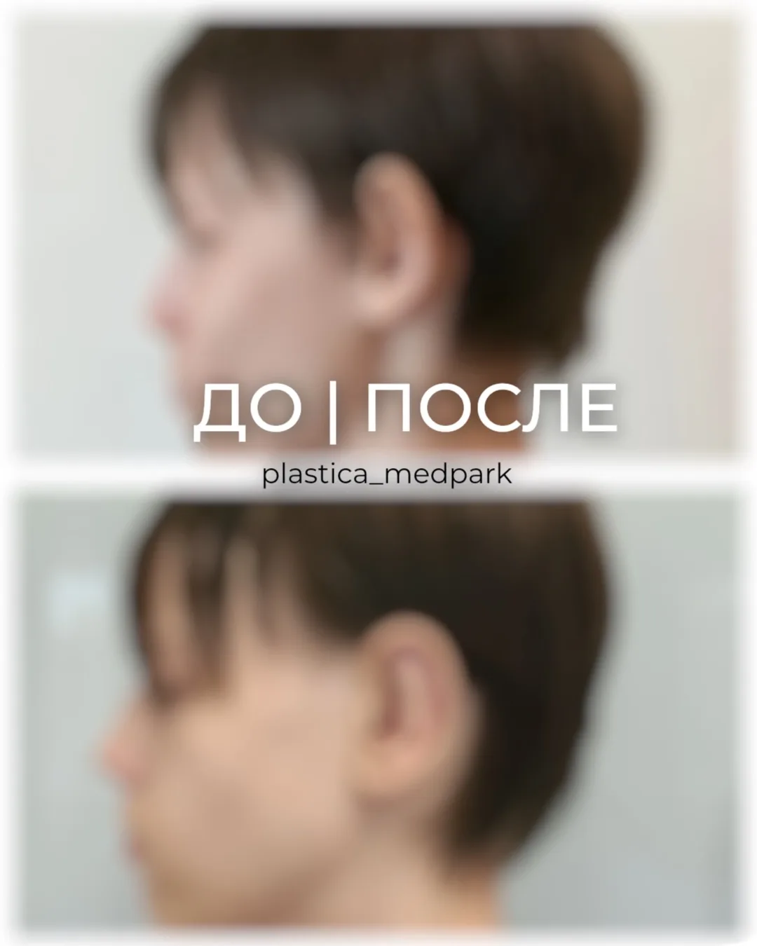 Результат спустя 1 месяц  после отопластики (коррекция формы ушных раковин)🍃