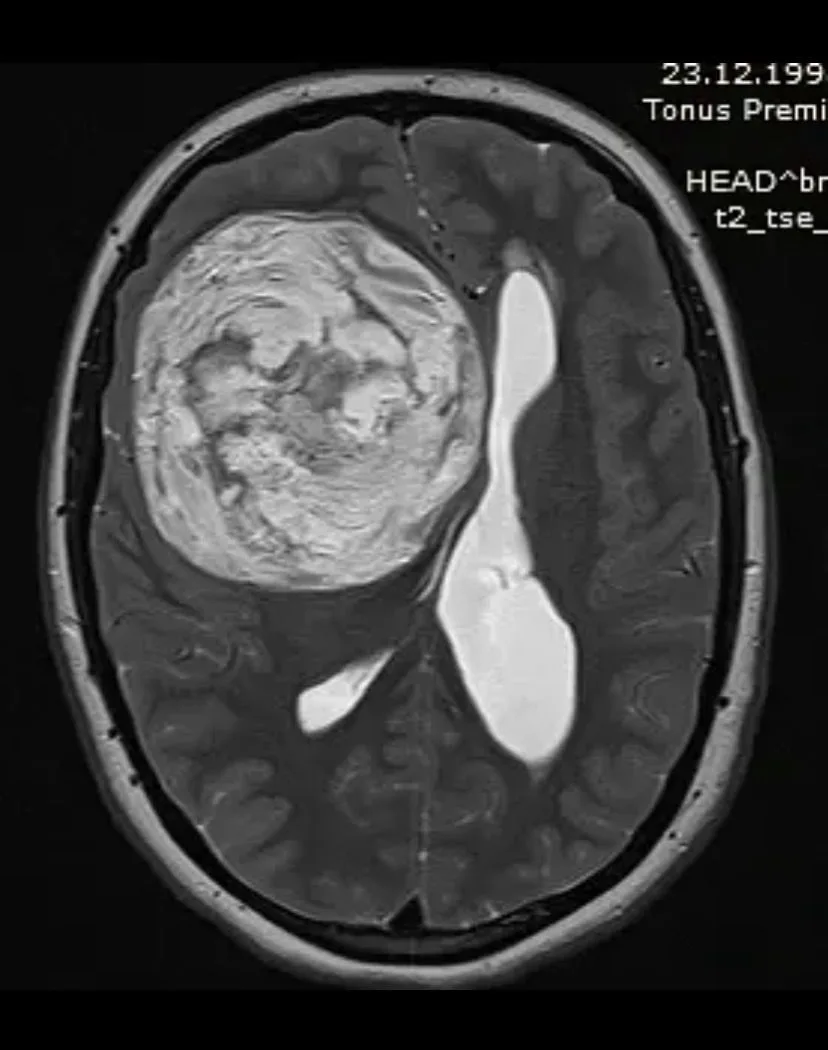 🧠 Гигантскую опухоль в голове удалили у нижегородки в больнице №13