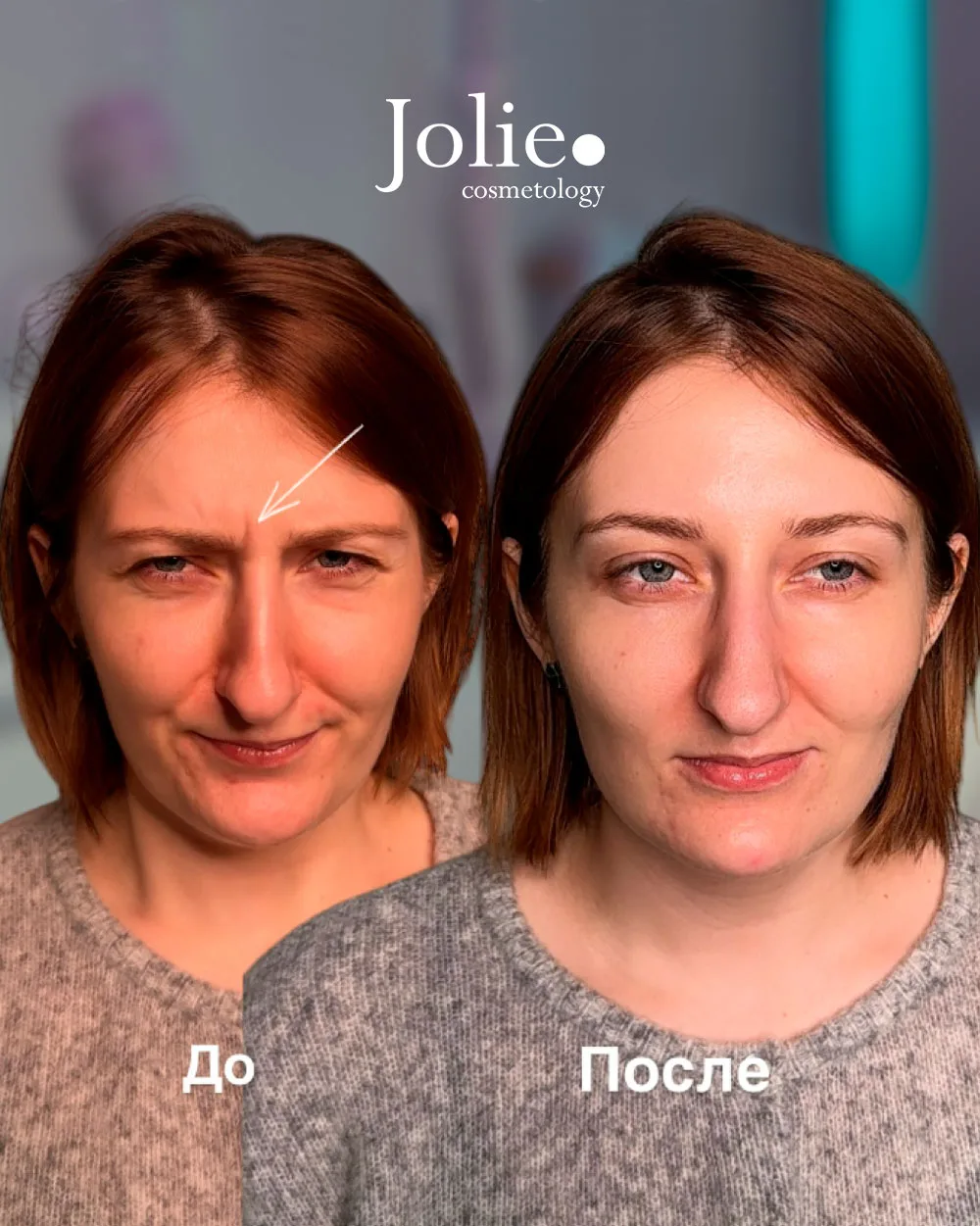 Ботокс фулфейс👇