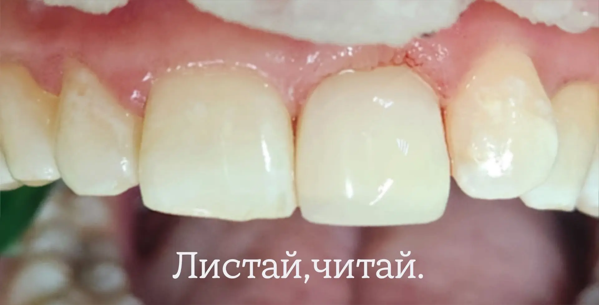 🛑 СТОП! Не спешите обтачивать потемневший зуб под коронку после травмы.