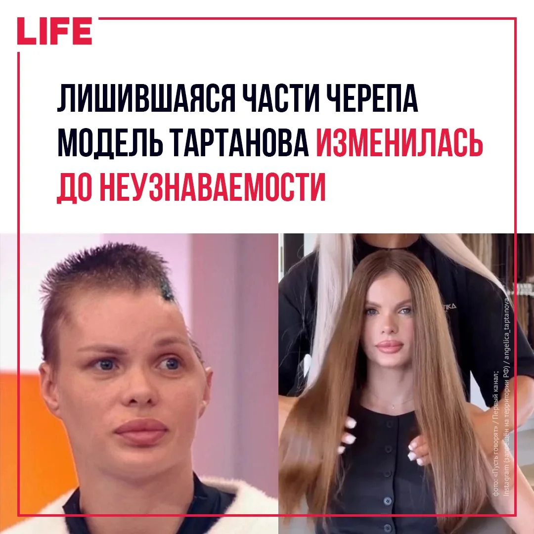 Краснодарская модель Анжелика Тартанова, получившая тяжёлые травмы головы после избиени...