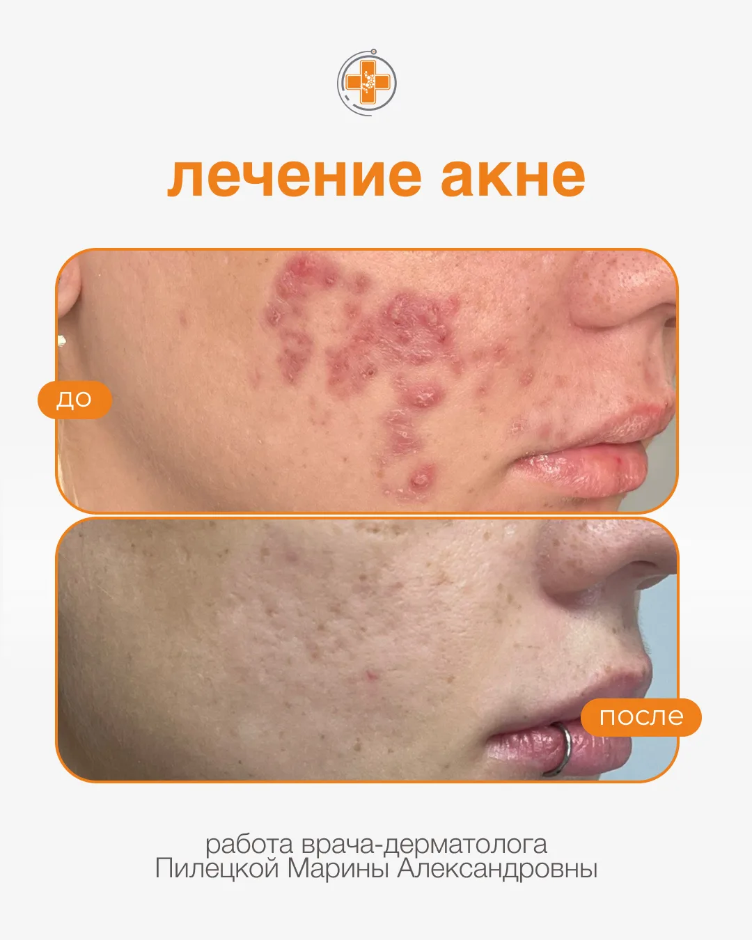 На фото - результаты успешной работы по ведению пациентов с акне у врача-дерматолога Пилецкой Марины
