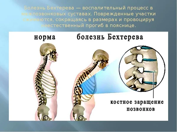Конечно. Давайте детальнее разберем два самых важных момента в лечении болезни Бехтерев...