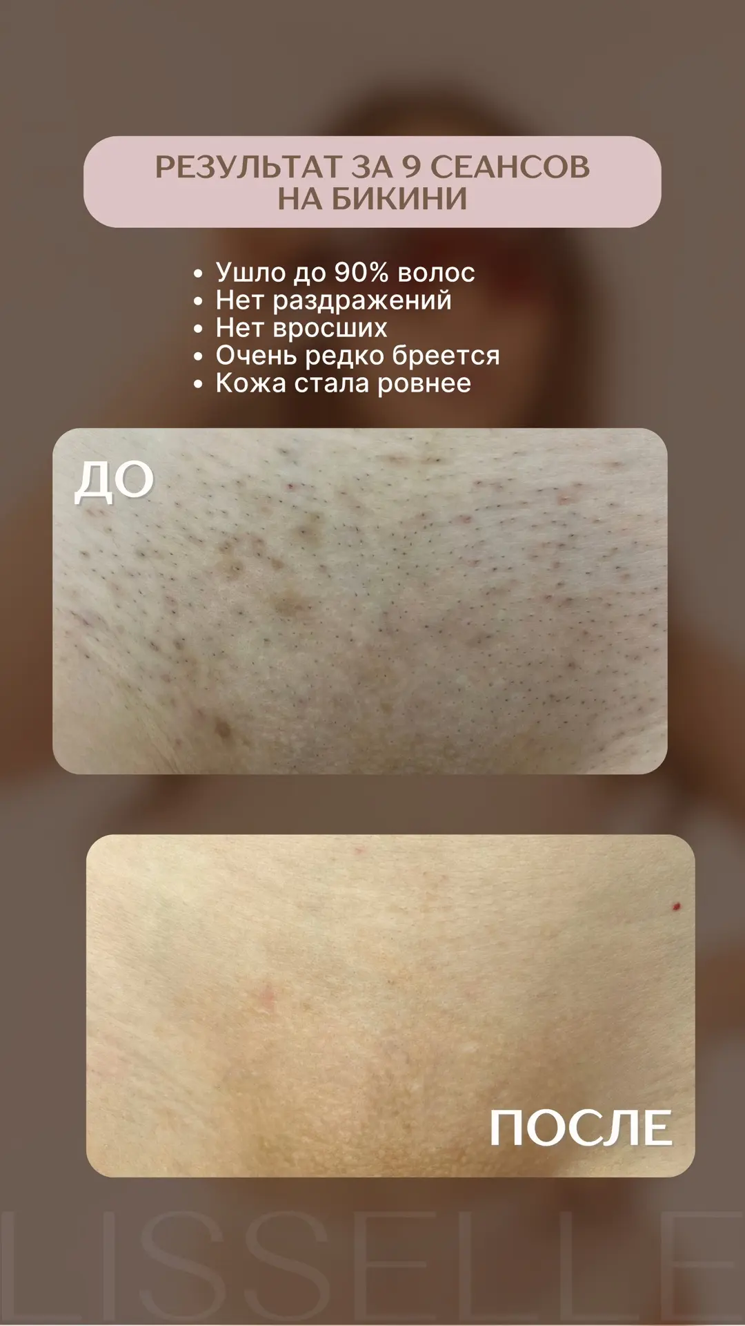 Давно мы не делились с вами потрясающими результатами наших клиентов после процедур лаз...