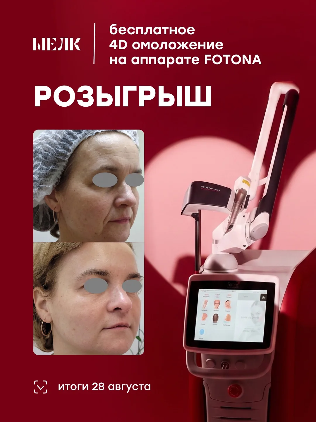 Дарим омоложение на Fotona 4D ✨