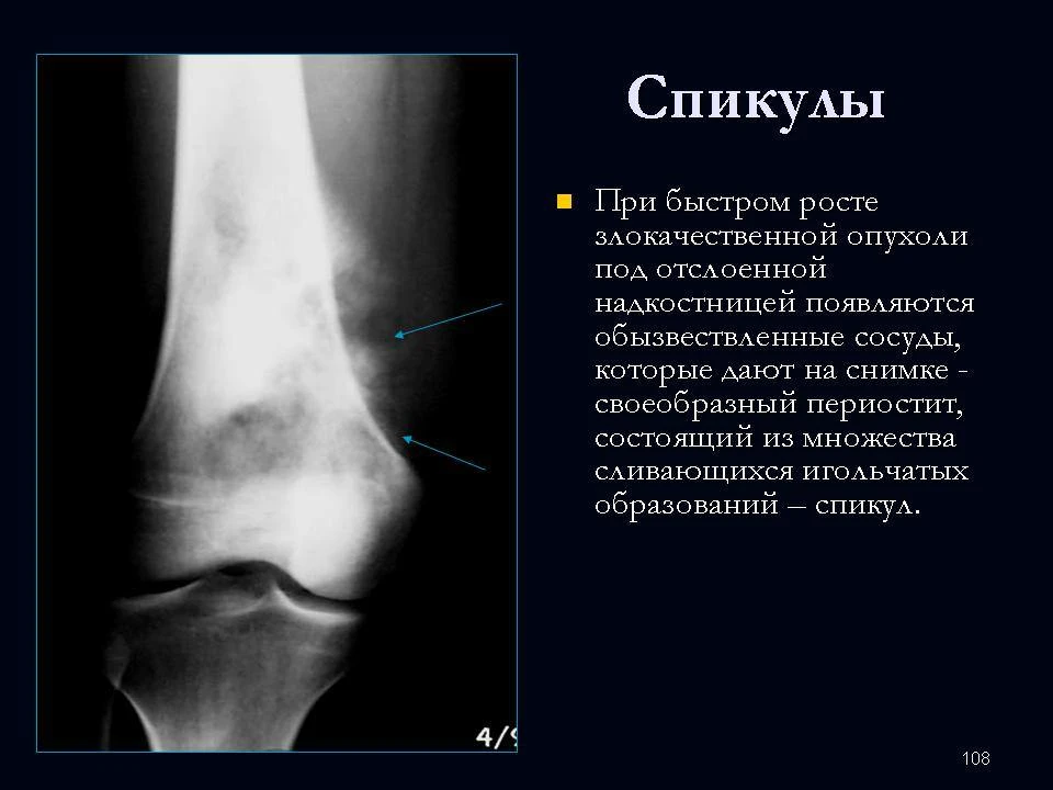 Спикулы