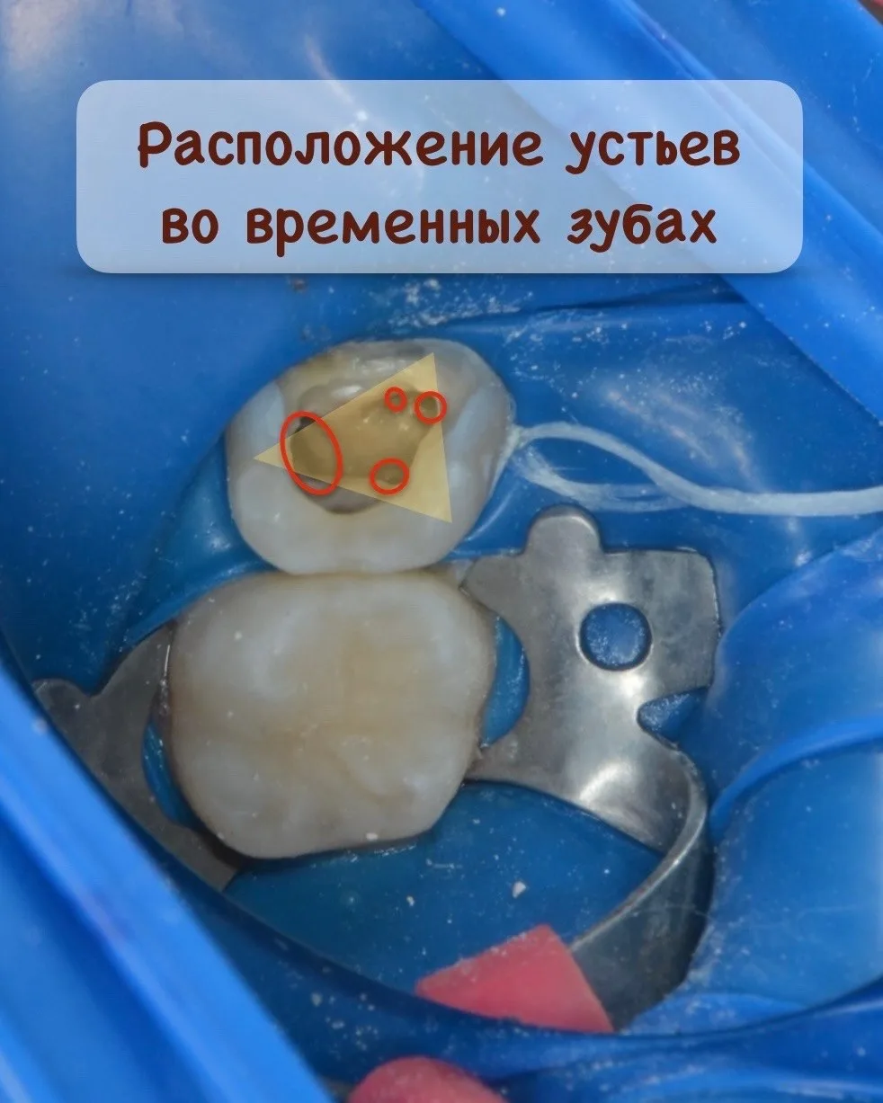 🦷 Расположение устьев во временных зубах