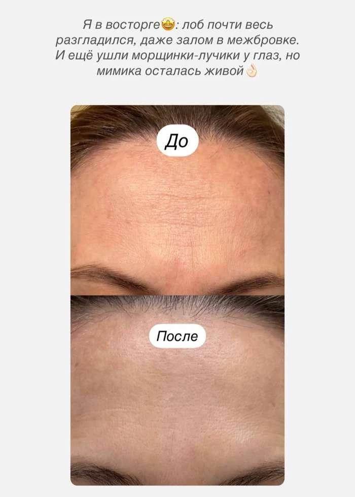 А может, ботокс вам пока не нужен?