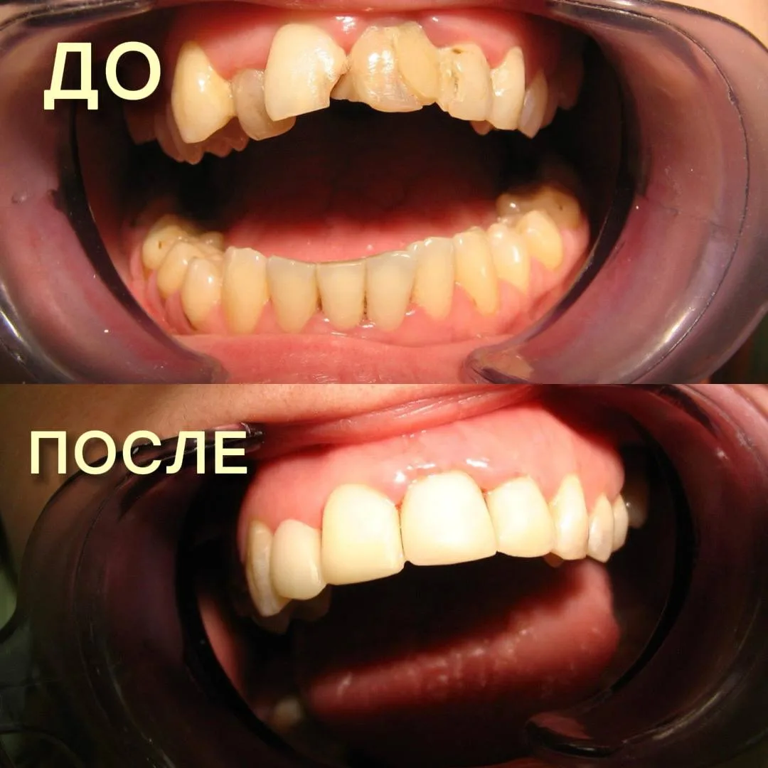 Красивая улыбка за один визит — реальность!