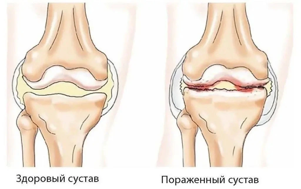 Эти советы помогут при артрозе ✍️