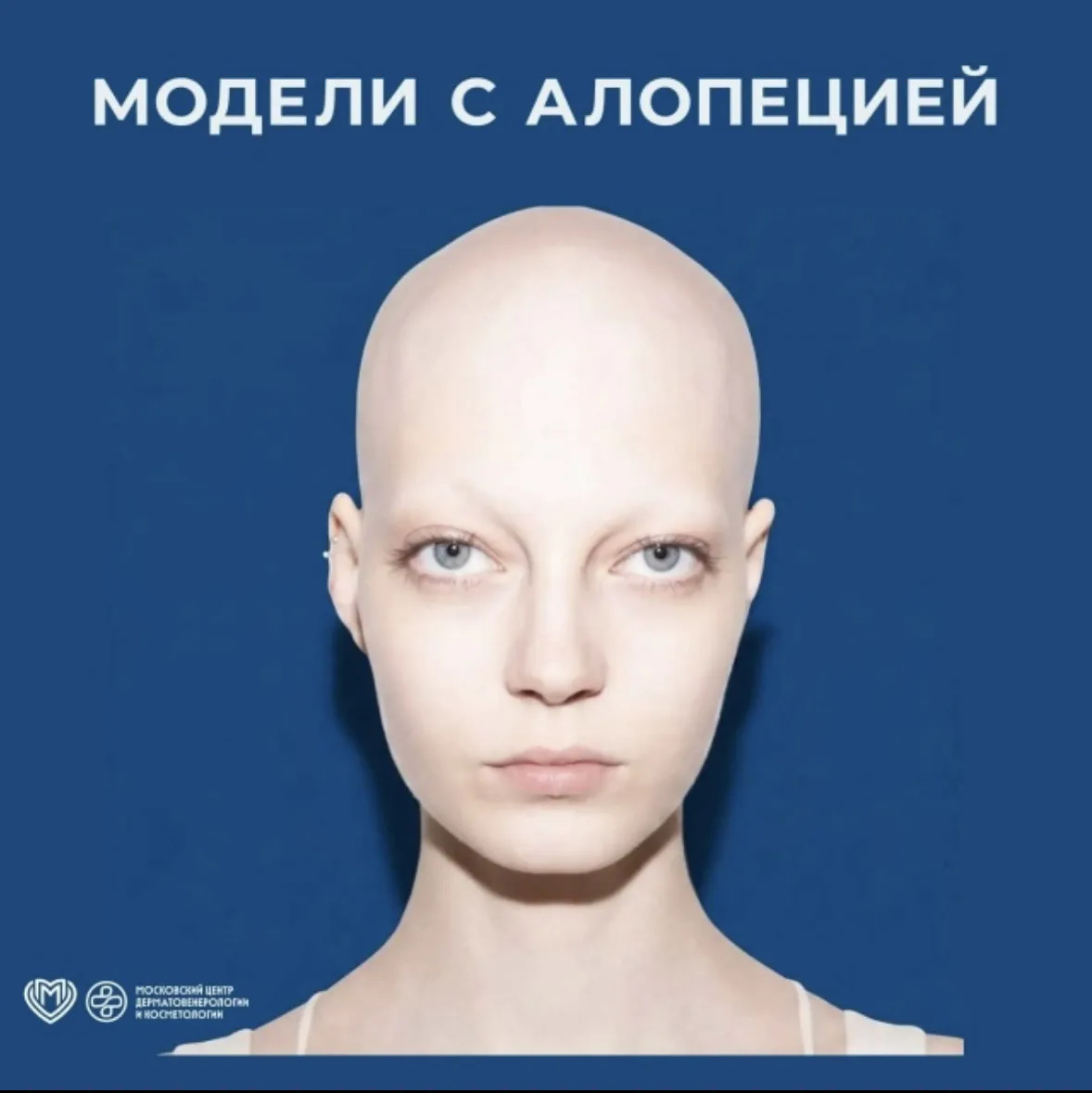 ✅Алопеция - медицинский термин, обозначающий потерю волос. Вопреки распространенному ми...