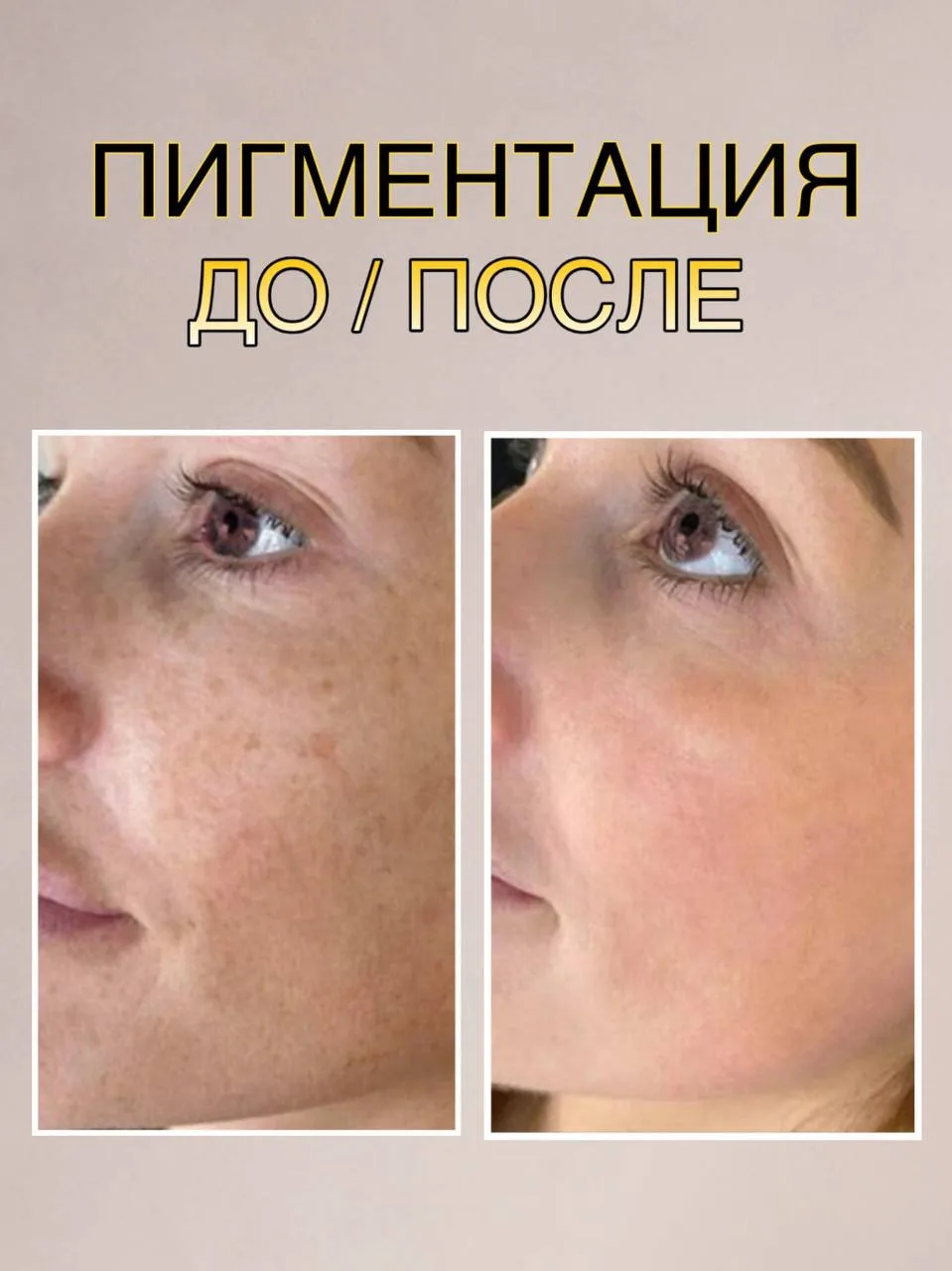 💫IPL терапия - это воздействие широкополосным интенсивным импульсным светом, во время процедуры све