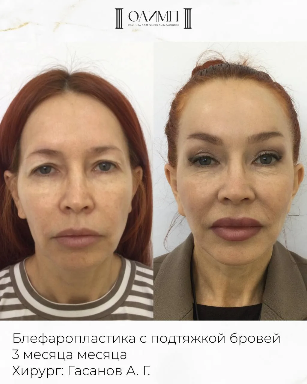 Была выполнена блефаропластика и подтяжка бровей.
Результат спустя 3 месяца после операции.
Хирург: 