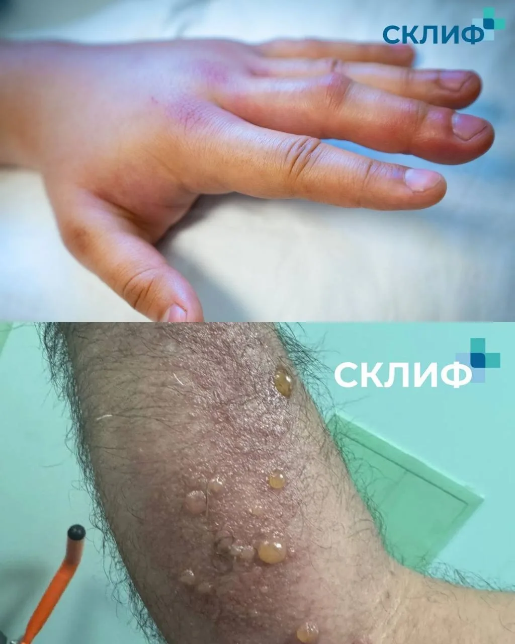 🐍 Москвич чуть не умер, дав змее укусить себя ради иммунитета к яду.