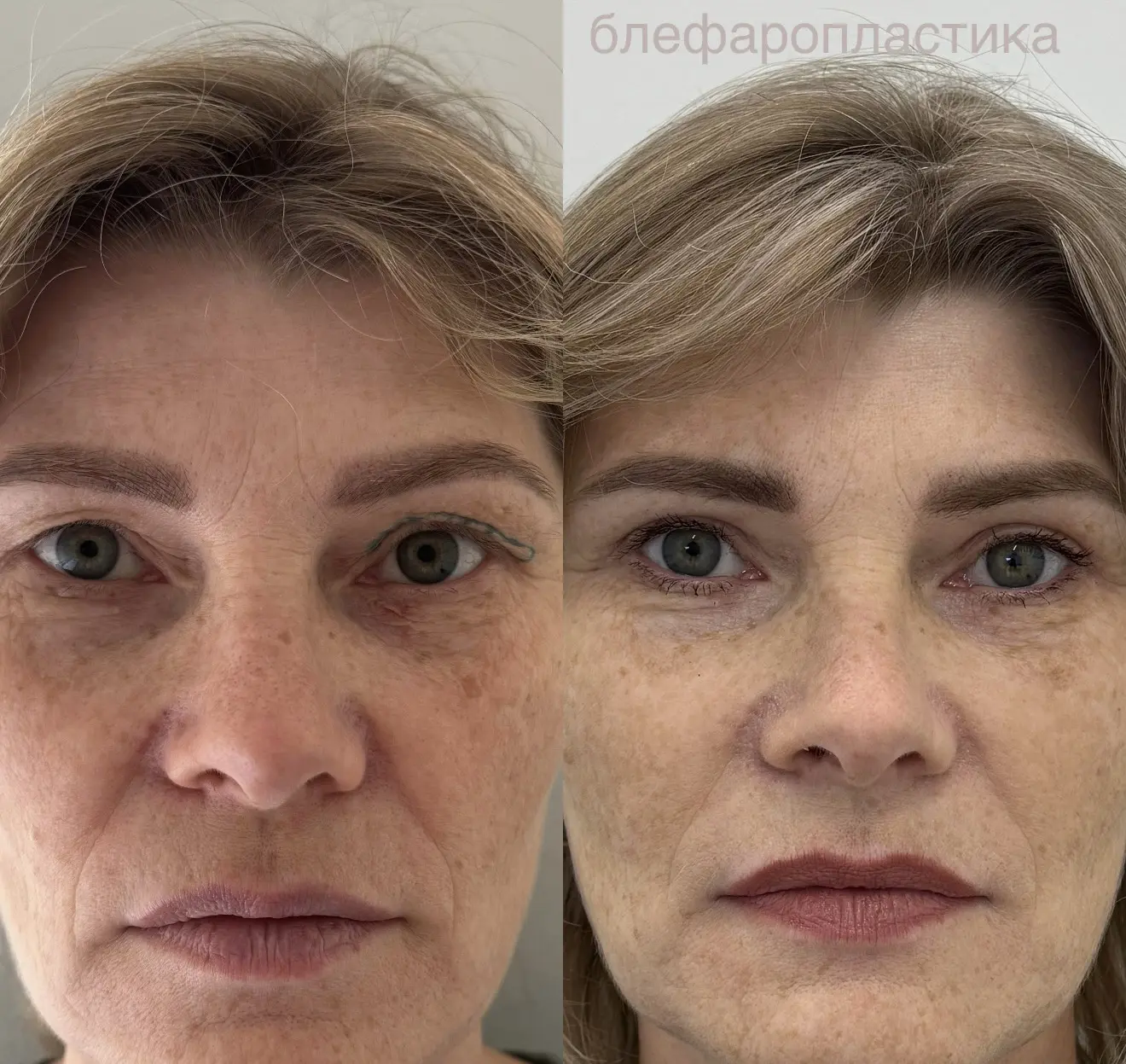 🏆 Лучший пластический хирург по блефаропластике 2023 г.  Flagman Beauty & Health - Пин...