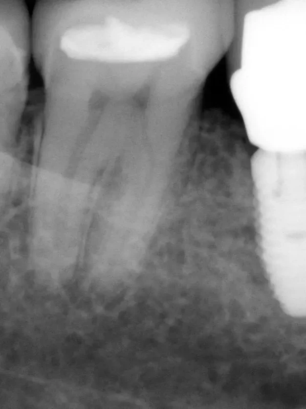 🦷 Сегодня хочу с вами разобрать одну реальную клиническую ситуацию, которая частенько ...