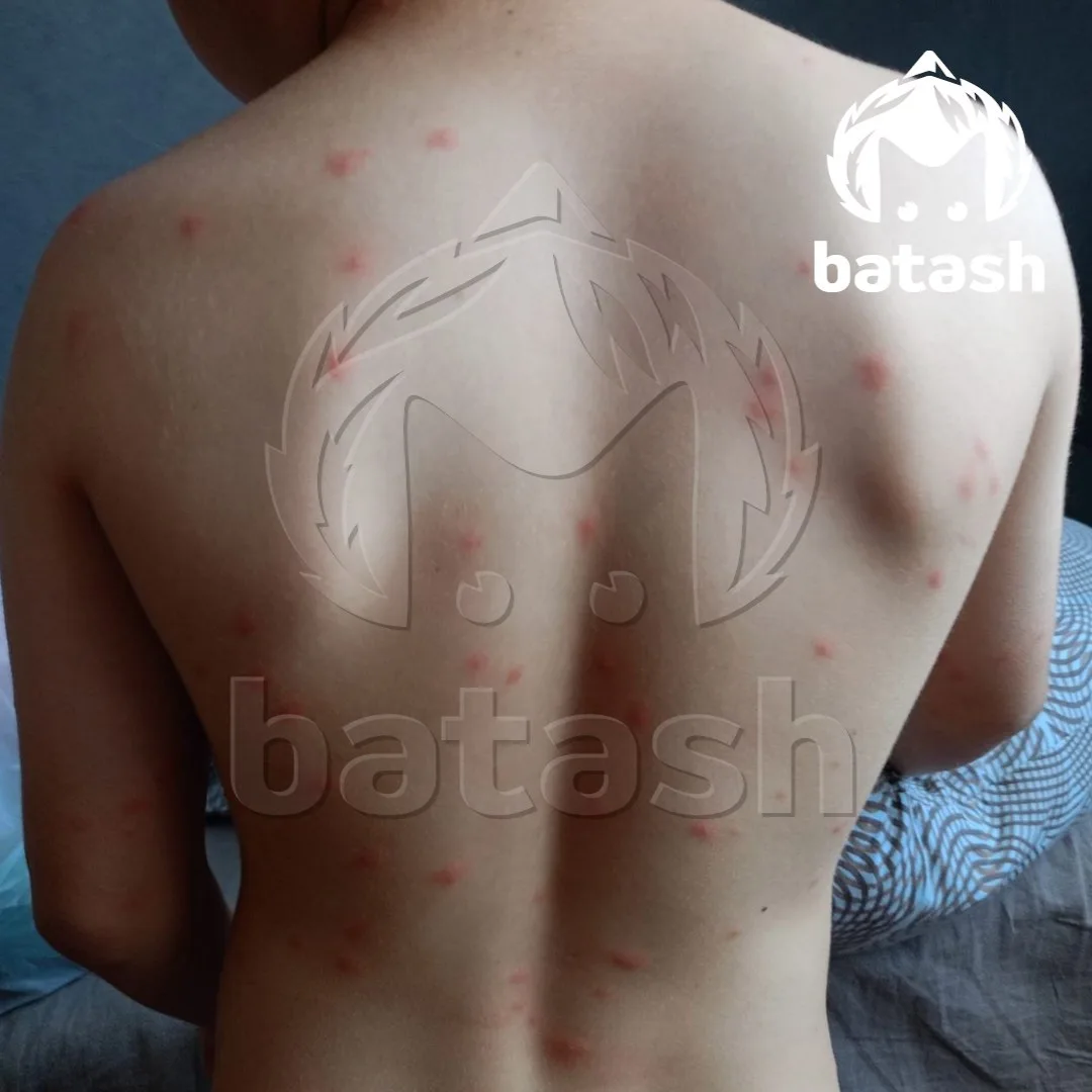 Зудящие волдыри вылезли на телах уфимцев после купания в Кашкадане.