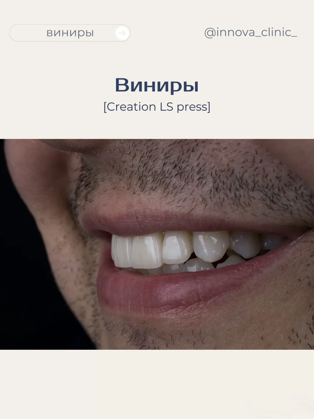 Сделать виниры так, чтобы окружающие не поняли, что они есть — вот настоящая эстетика)
