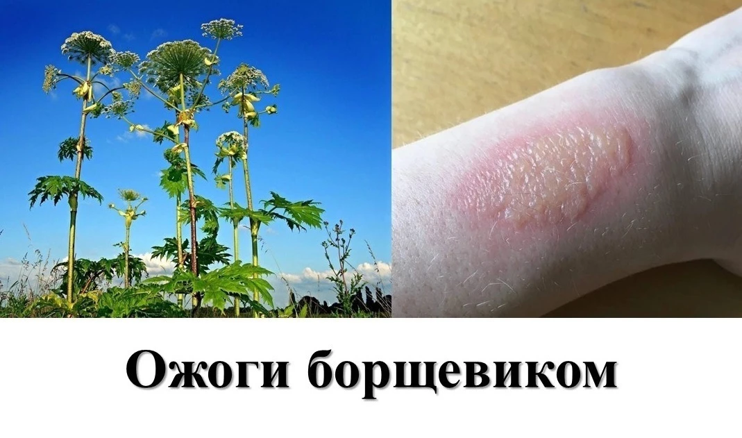 Рак молочной железы