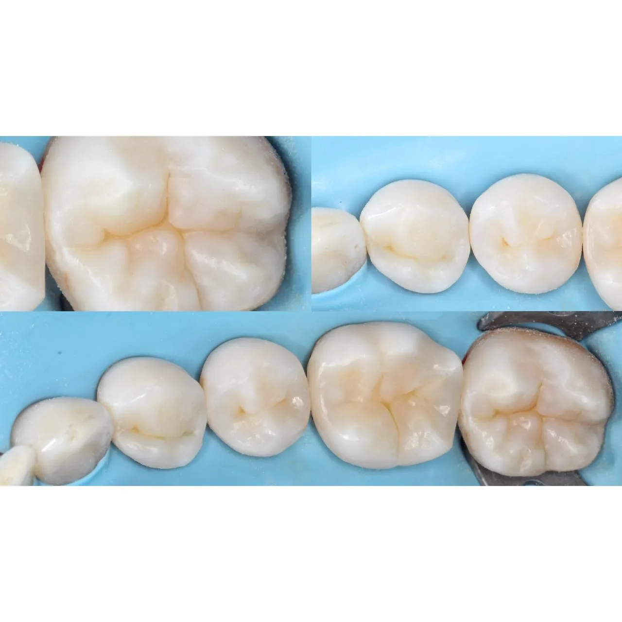 🦷Реставрация жевательного сегмента

-LC Ceramic nano a2e a3e 
-LC Nano flow ble  
-Ochre

Автор: Ни