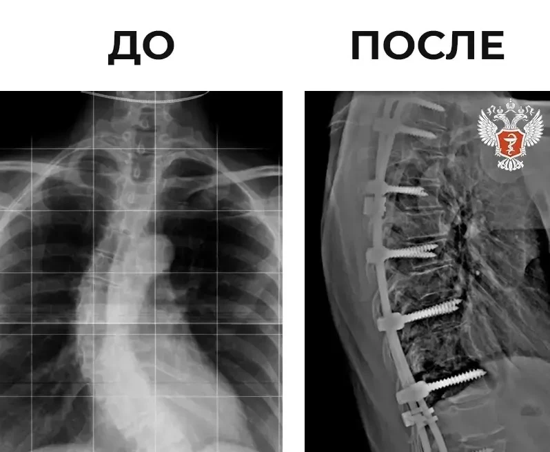🩺 Нейрохирурги Ярославской области исправили пациентке тяжелый вид сколиоза   57-летняя женщина пост