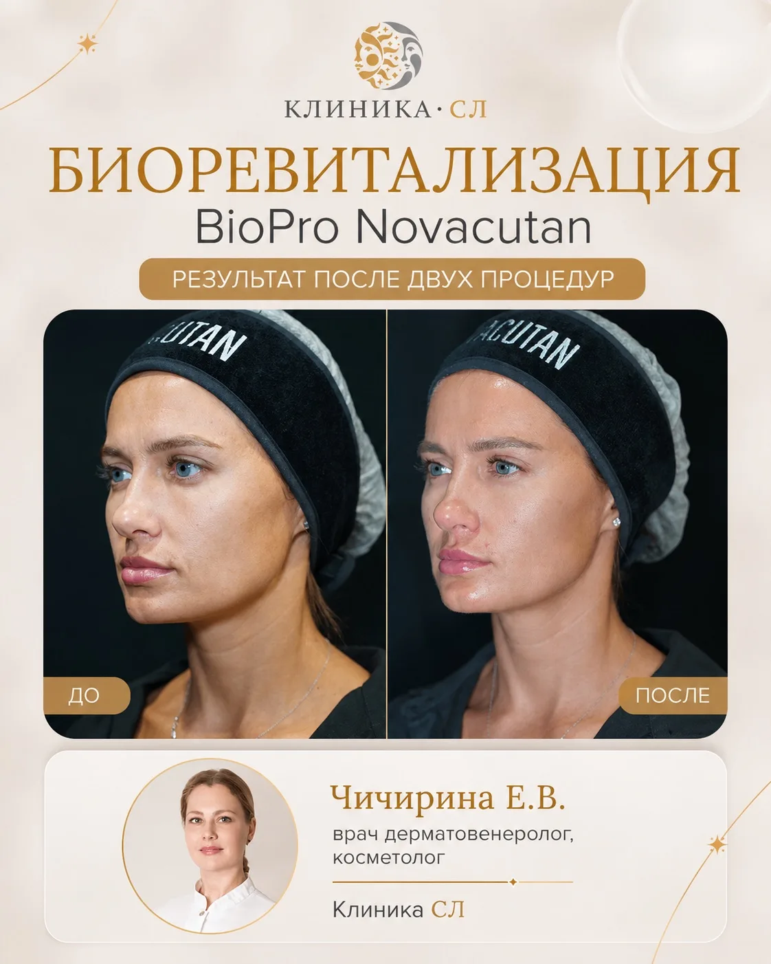 BioPro Novacutan: результат после 2 процедур ✨