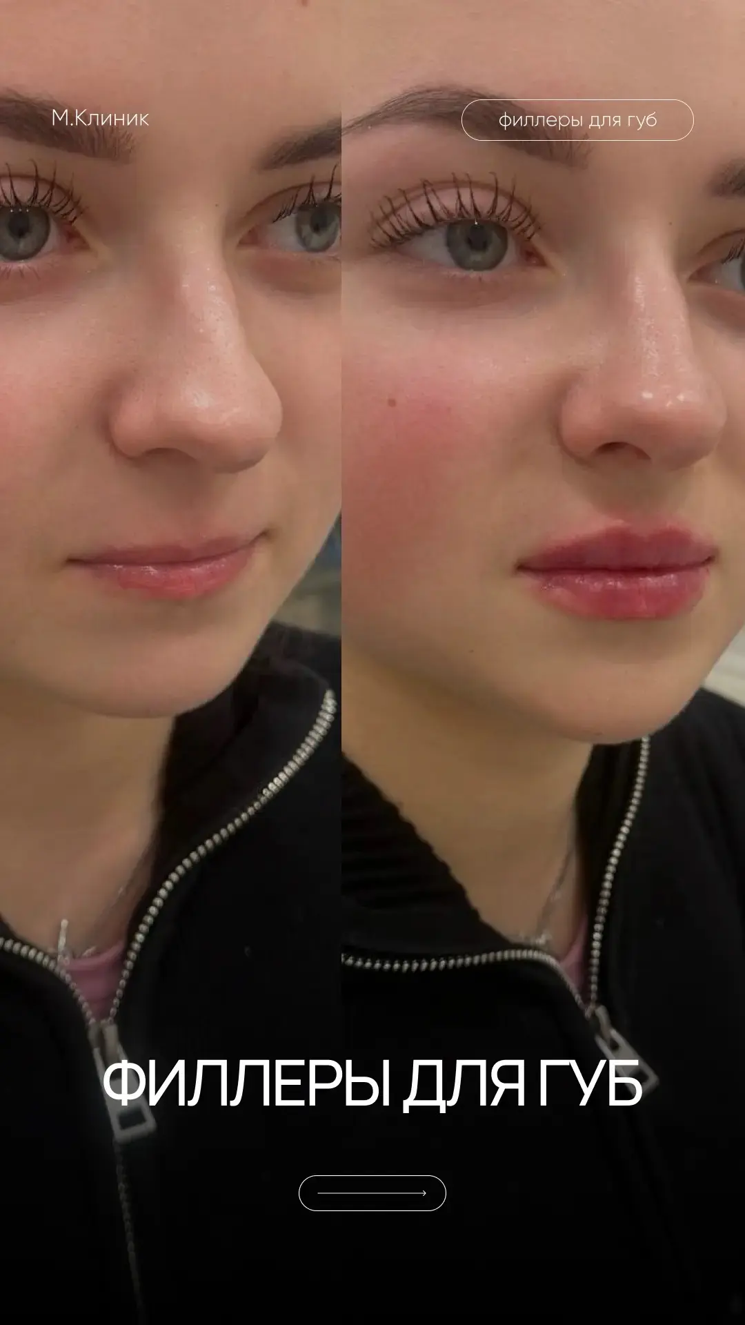 Филлеры для губ: от «свои, только свежее» до «новая форма» 💉👄