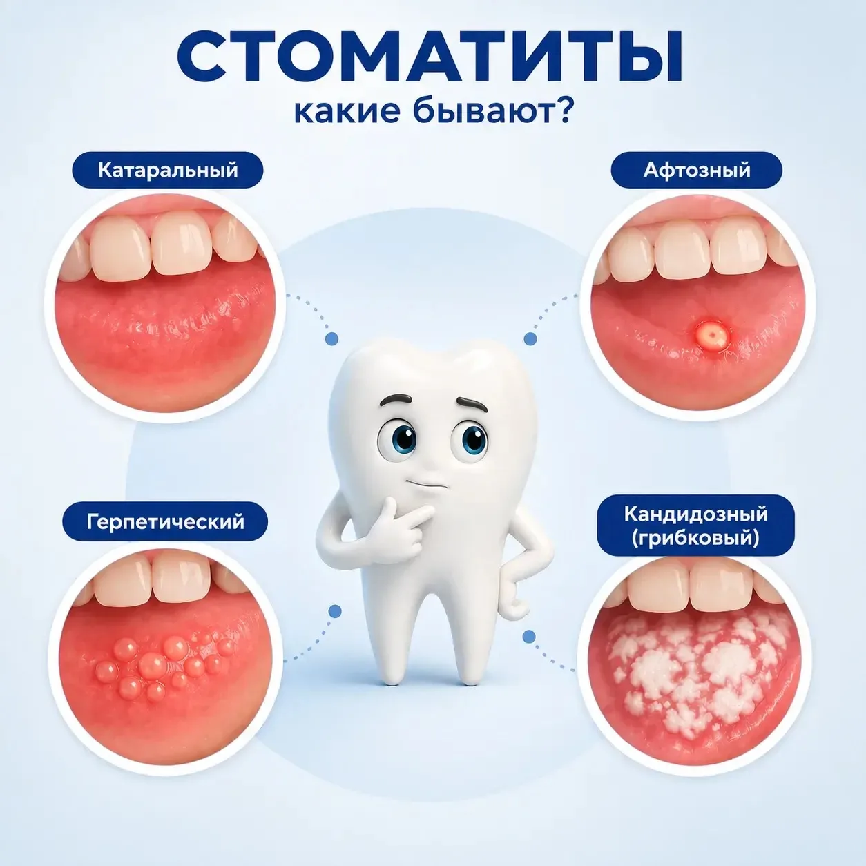 Стоматиты: виды, причины, как проводят лечение и какие обследования могут назначить.