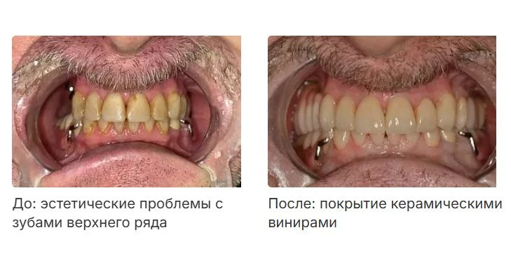 8 ВИНИРОВ В 62 ГОДА. «ЖЕНА СКАЗАЛА — Я ПОМОЛОДЕЛ НА ДЕСЯТЬ ЛЕТ»