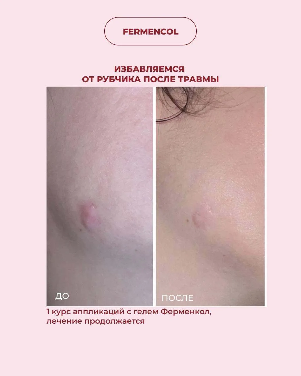 Рубец после травмы? Это не проблема для Ферменкол!