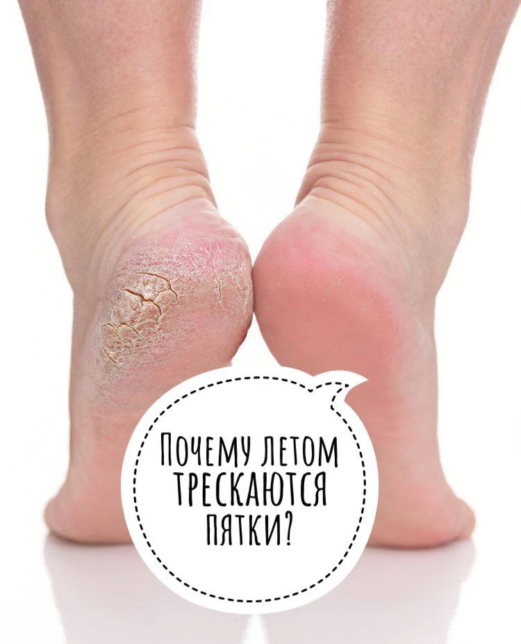 Почему летом трескаются пятки?

Летом мы чаще ходим босиком или в открытой обуви, подвергая кожу ног