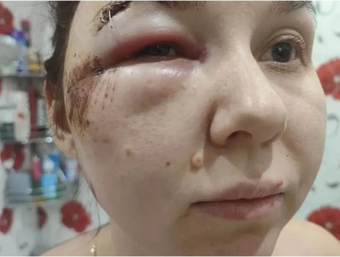 Жительница Назарово получила черепно-мозговую травму и сотрясение, упав в темноте в выр...