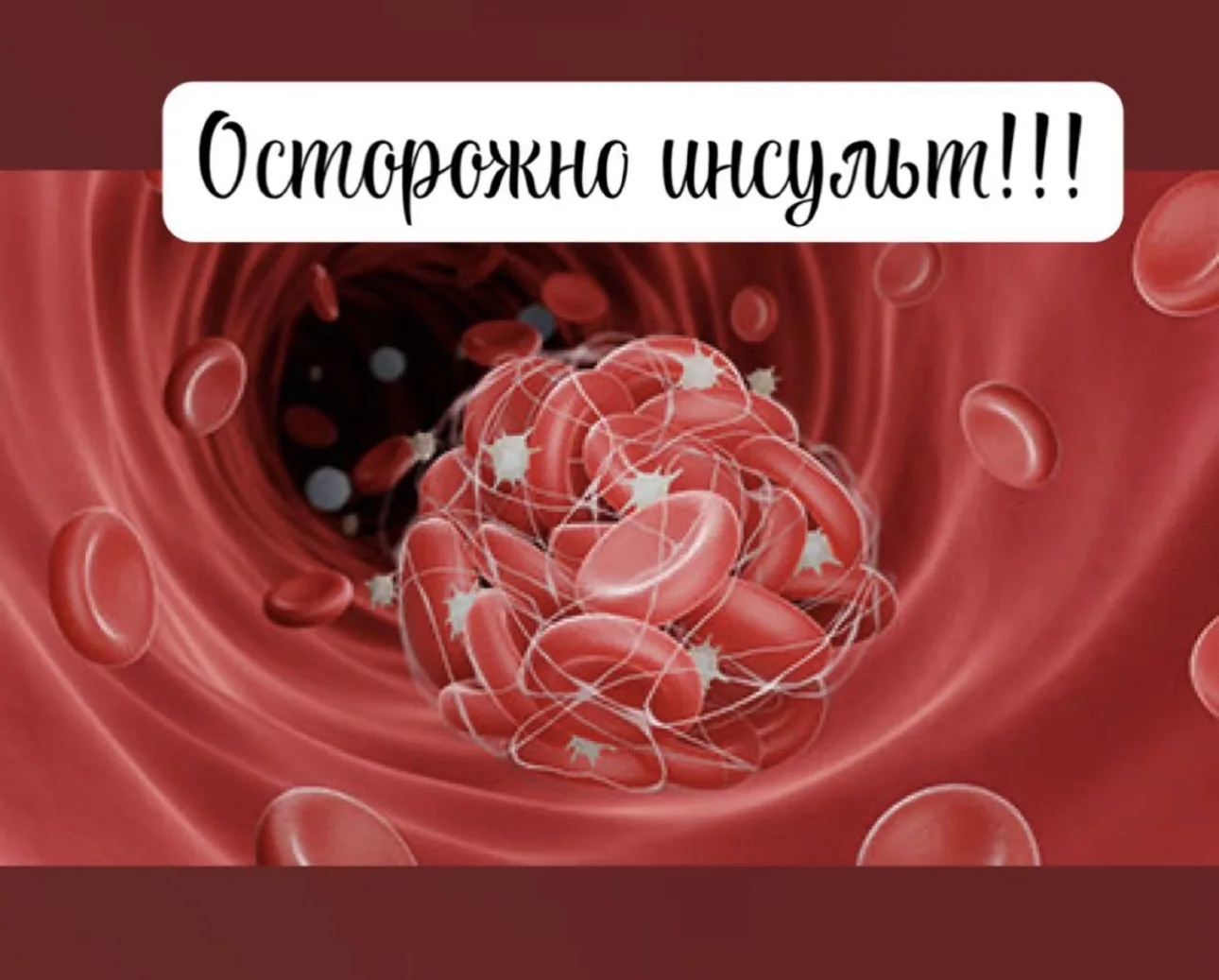 У ишемического и у геморрагического инсульта есть общие факторы, которые могут служить пусковым меха
