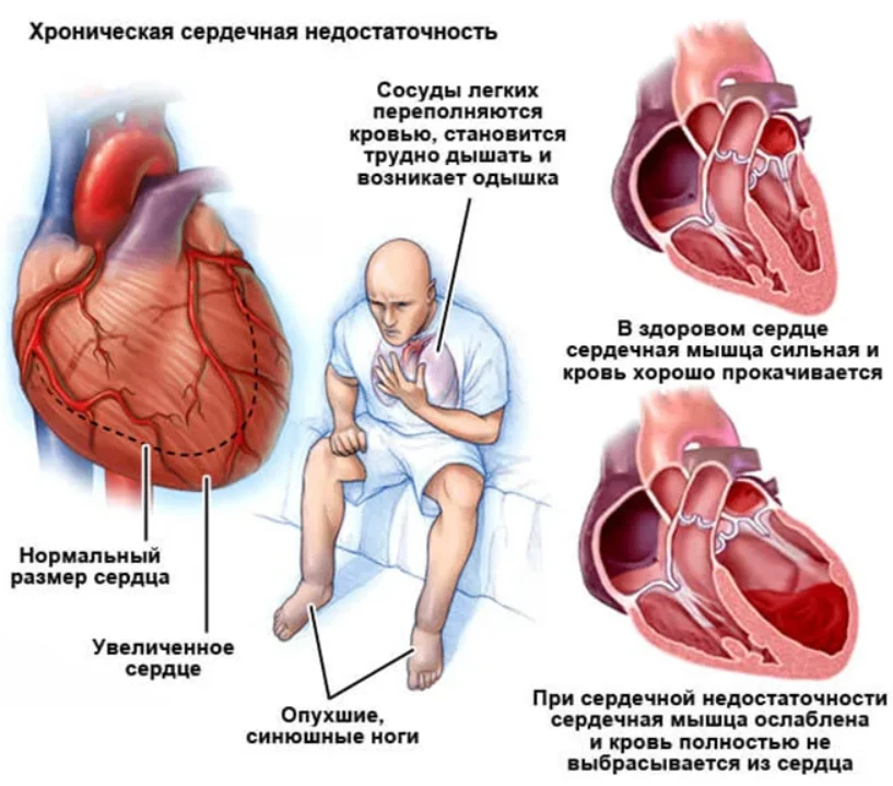 Хроническая сердечная недостаточность