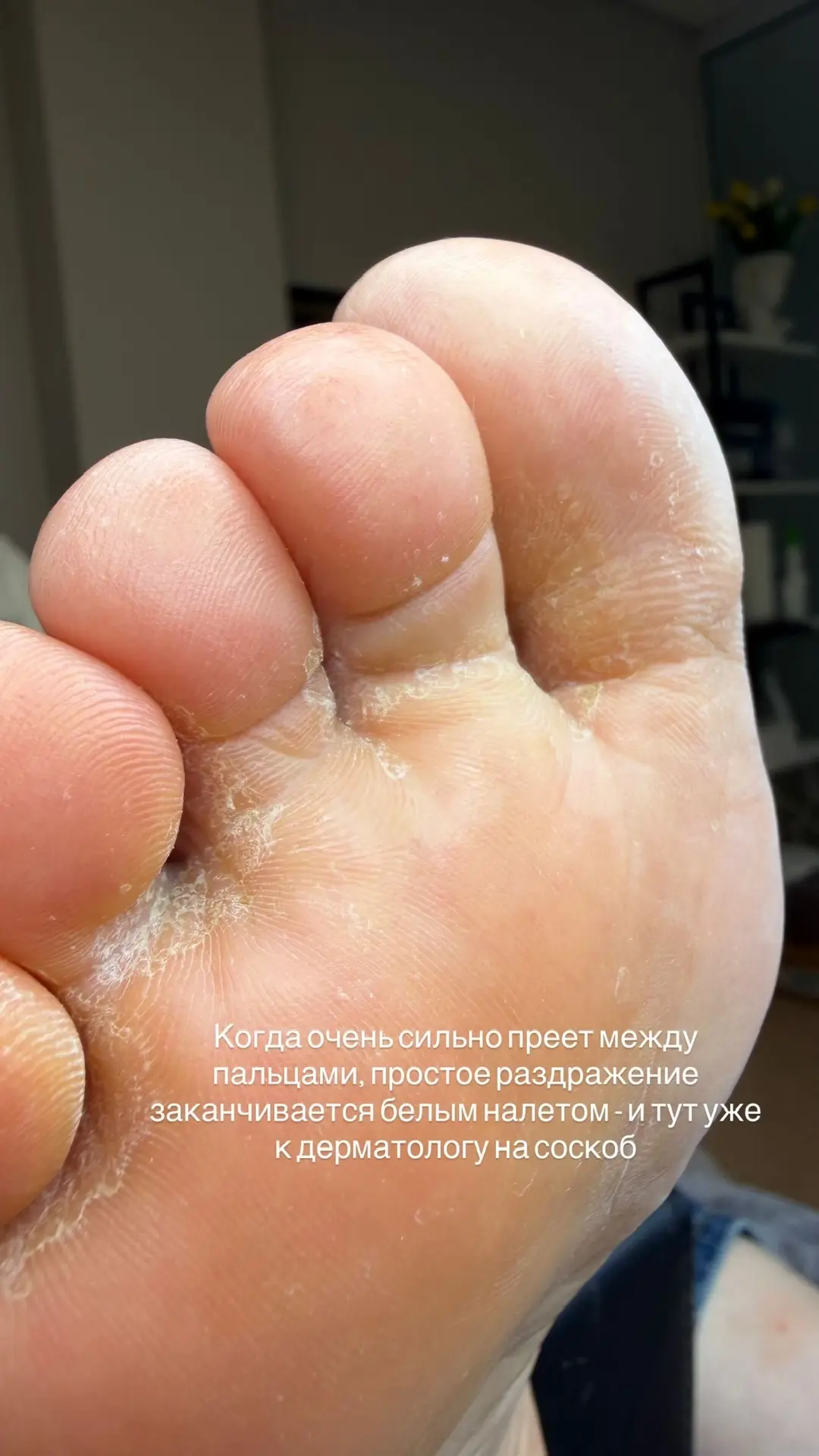 Про гипергидроз стопы.