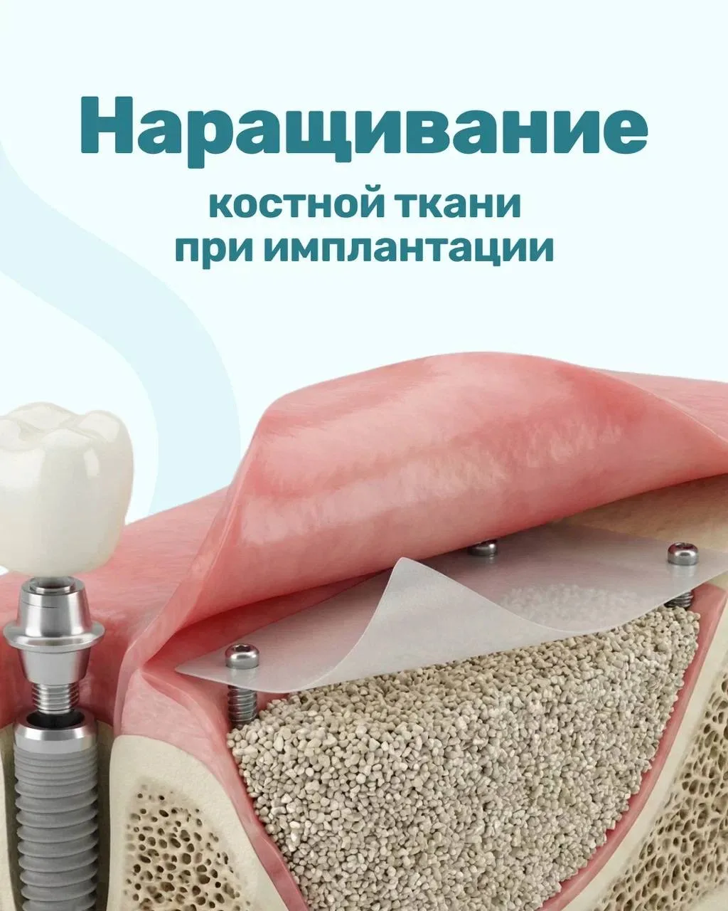 🦷 Наращивание костной ткани при имплантации: зачем оно нужно и можно ли без него обойт...