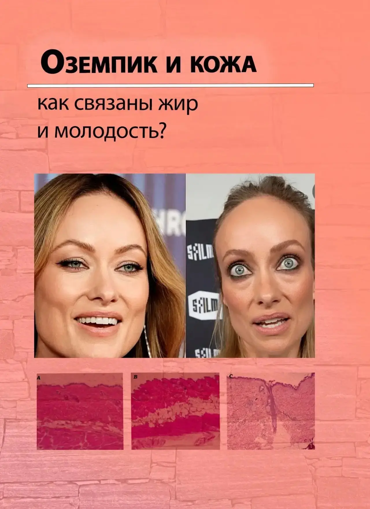 Звезды Голливуда, у которых изначально не было показаний к сильному похудению, сейчас с...