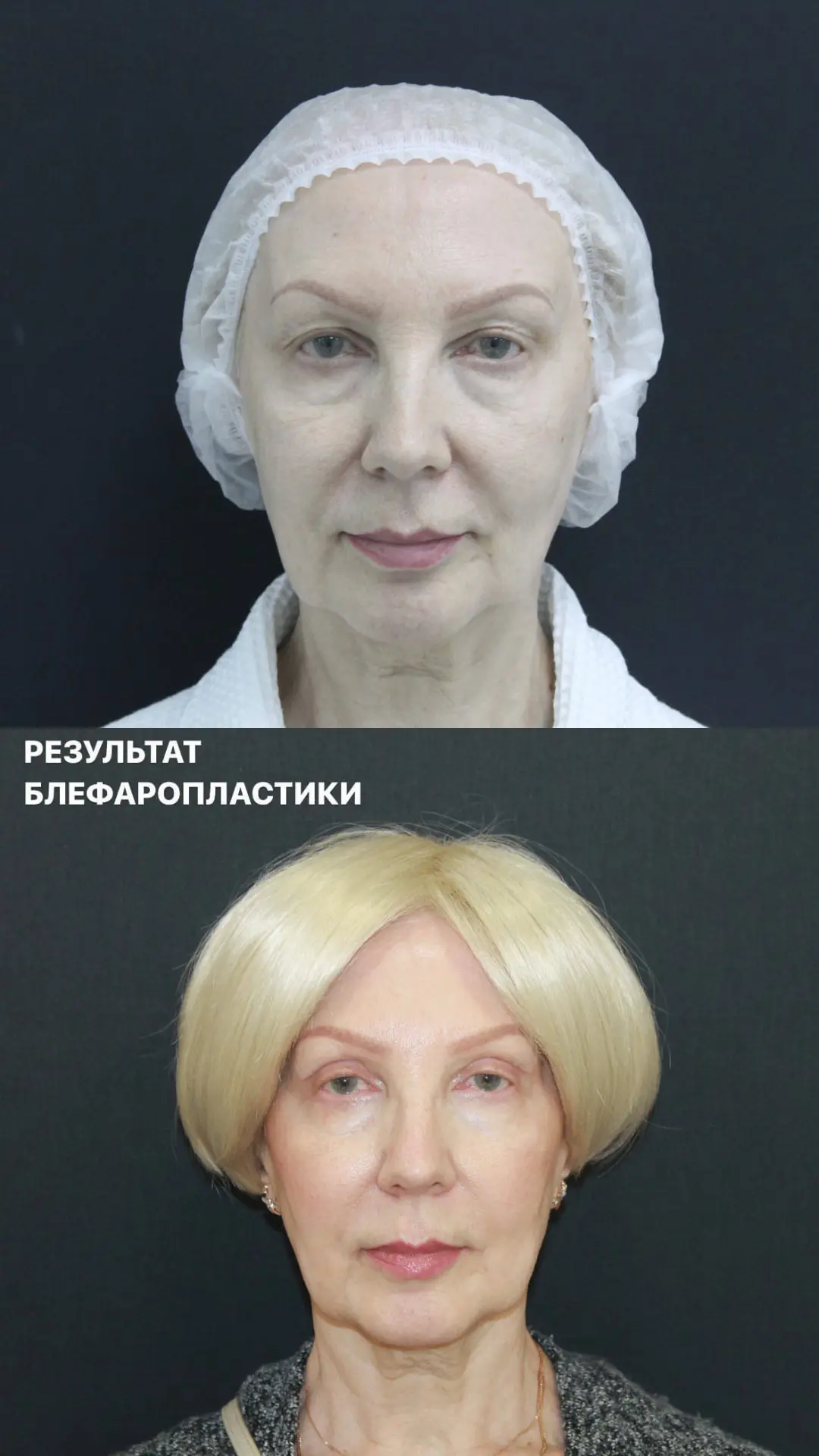 Ранний результат блефаропластики 😍