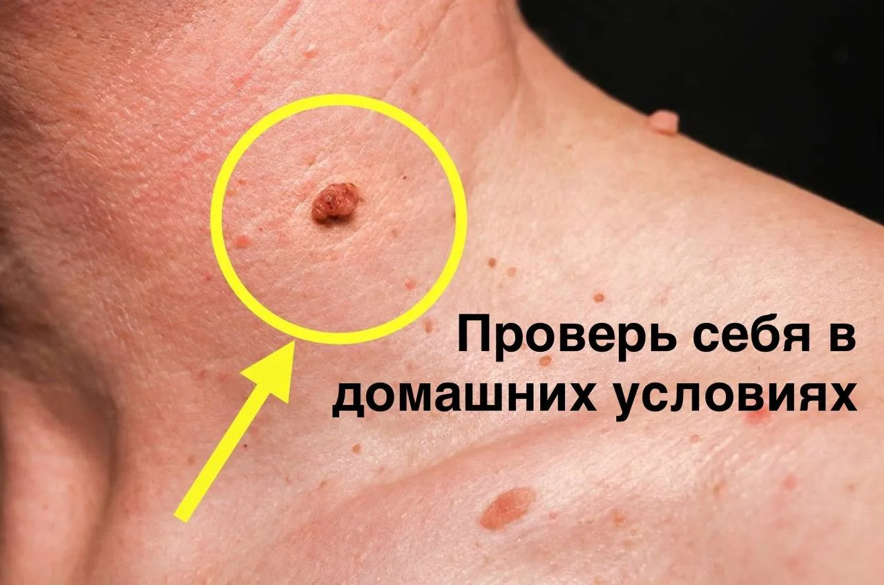 Это не бородавка — это рак, и ты можешь не успеть!  Когда на шее появилась странная "бородавка", я р